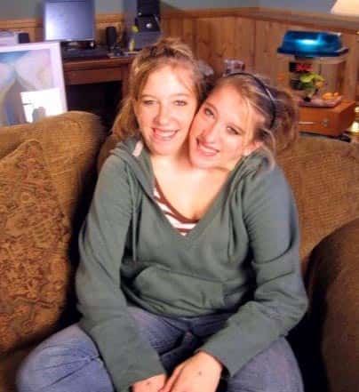30 Interesting Things About Famous Conjoined Twins Abby And Brittany Hensel