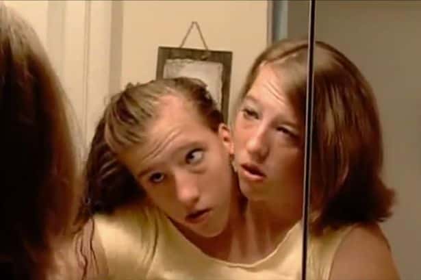 30 Interesting Things About Famous Conjoined Twins Abby And Brittany Hensel