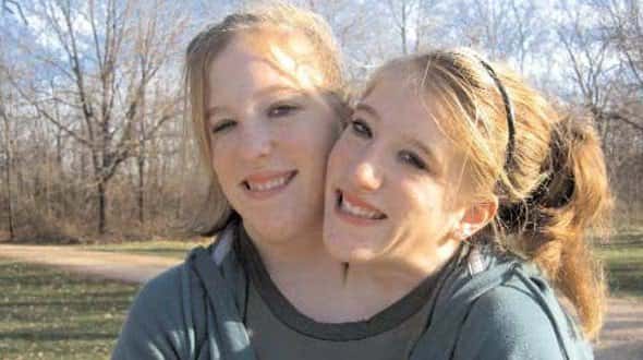 30 Interesting Things About Famous Conjoined Twins Abby And Brittany Hensel