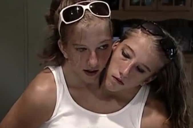 30 Interesting Things About Famous Conjoined Twins Abby And Brittany Hensel
