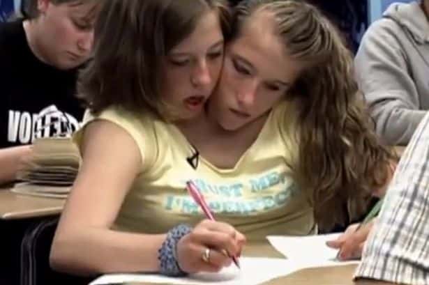 30 Interesting Things About Famous Conjoined Twins Abby And Brittany Hensel