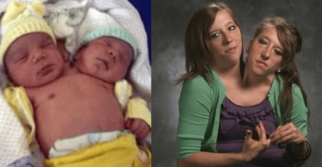 30 Interesting Things About Famous Conjoined Twins Abby And Brittany Hensel