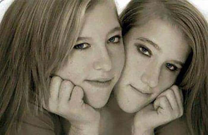 30 Interesting Things About Famous Conjoined Twins Abby And Brittany Hensel