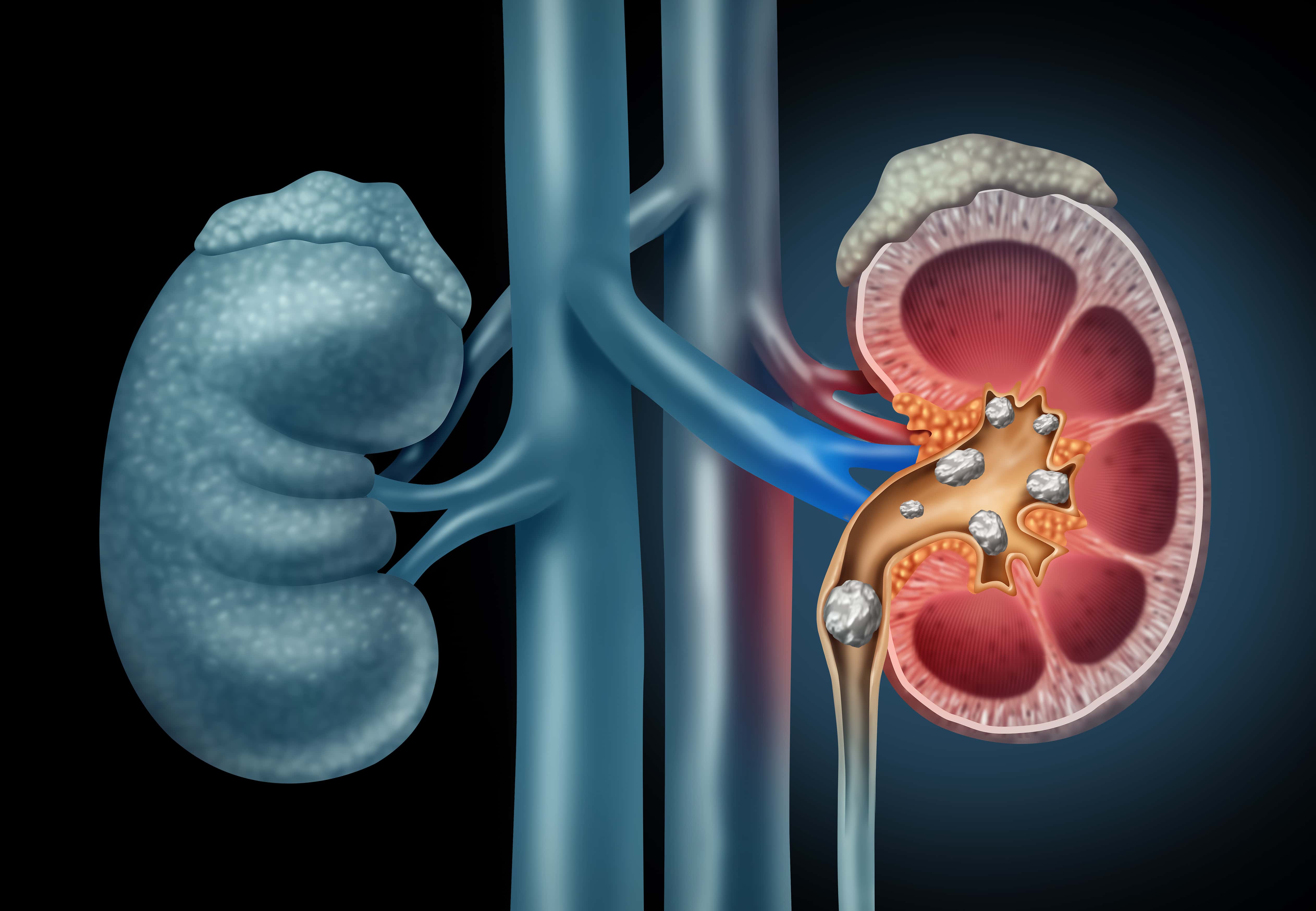 What Causes Kidney Stones?