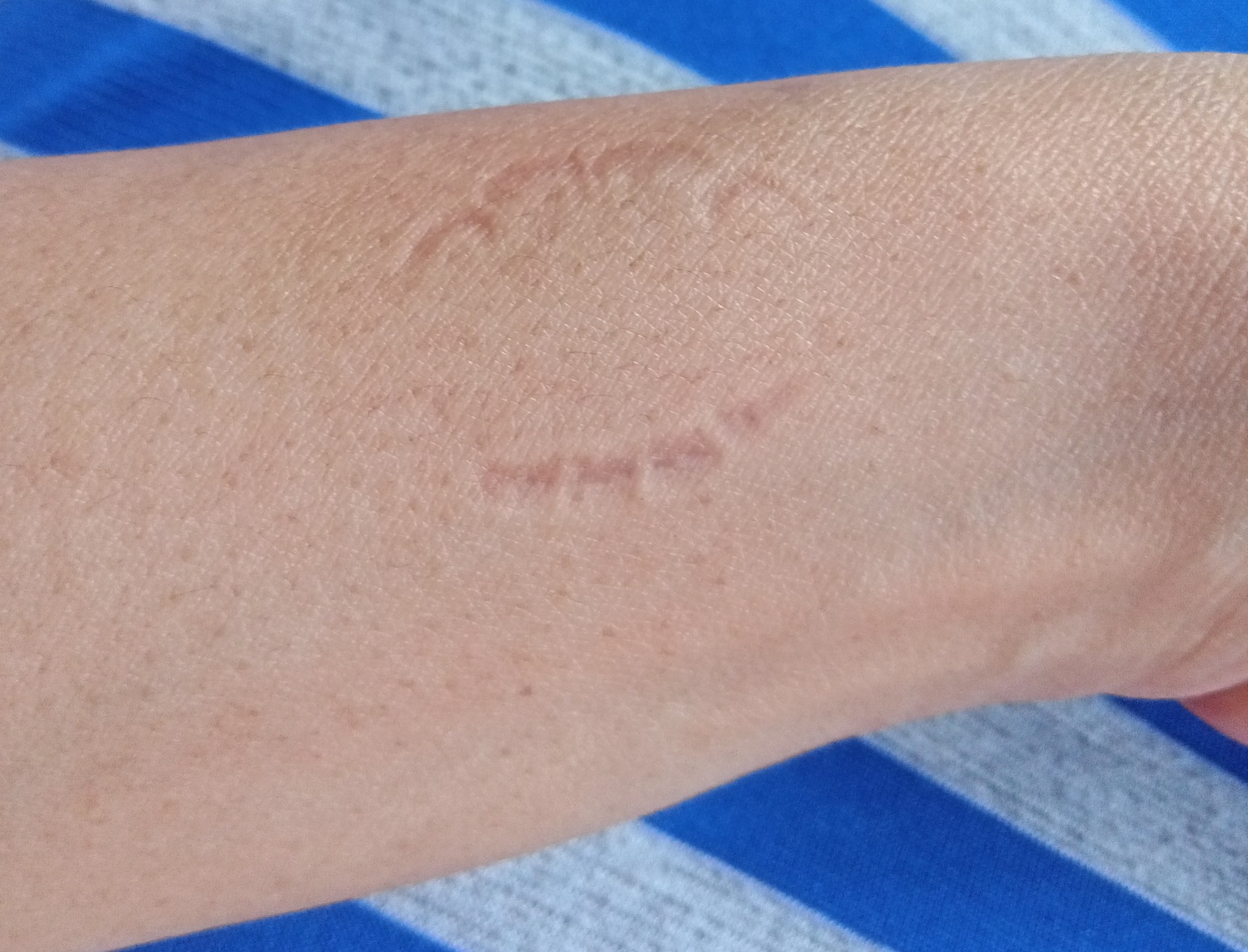 Man with bite mark on the hand.