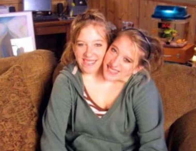 30 Interesting Things About Famous Conjoined Twins Abby And Brittany Hensel