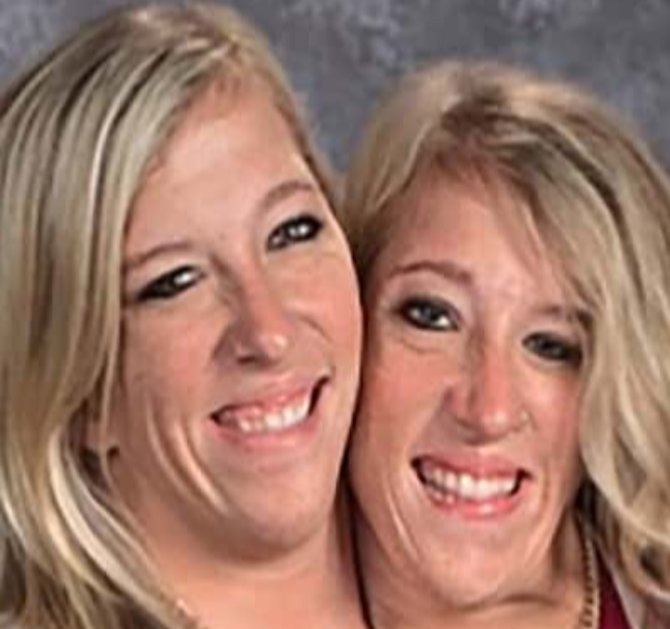 30 Interesting Things About Famous Conjoined Twins Abby And Brittany Hensel