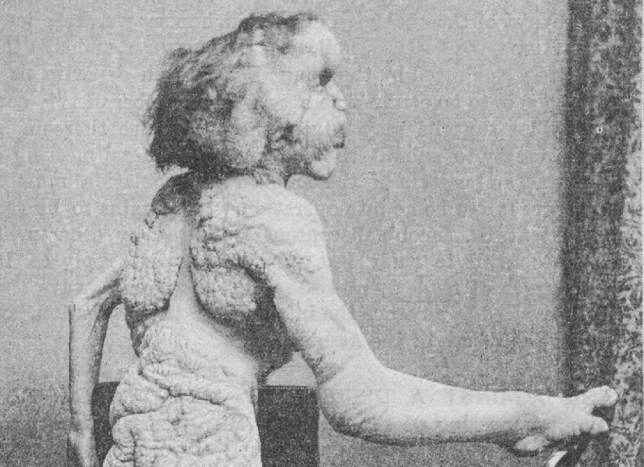 A photograph of Joseph Merrick, sometimes called the Elephant Man - 1889