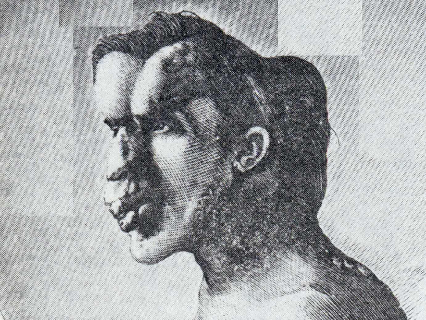 Image of Joseph Merrick, was published in the British Medical Journal - 1886