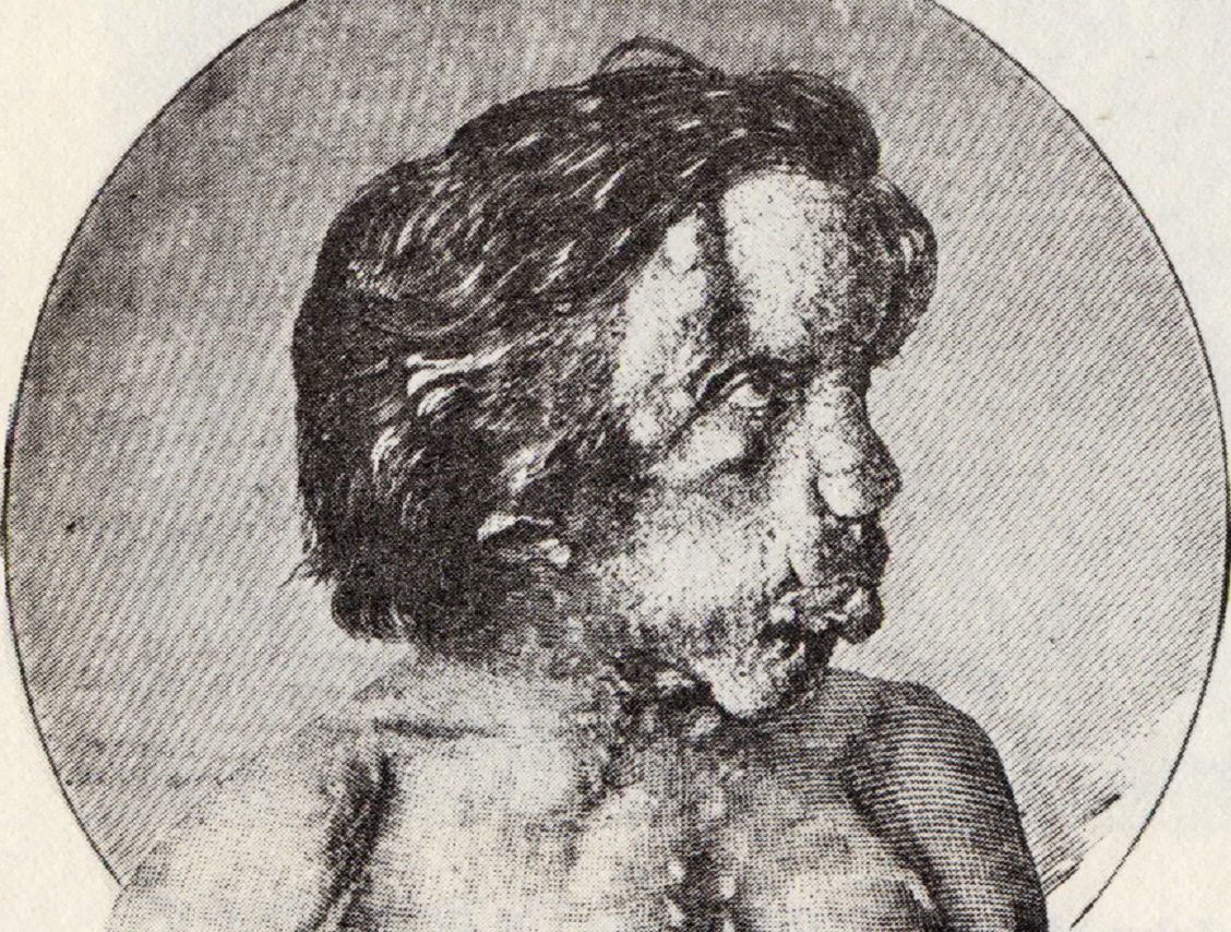 B&W image of Joseph Merrick looking at side - 1886.