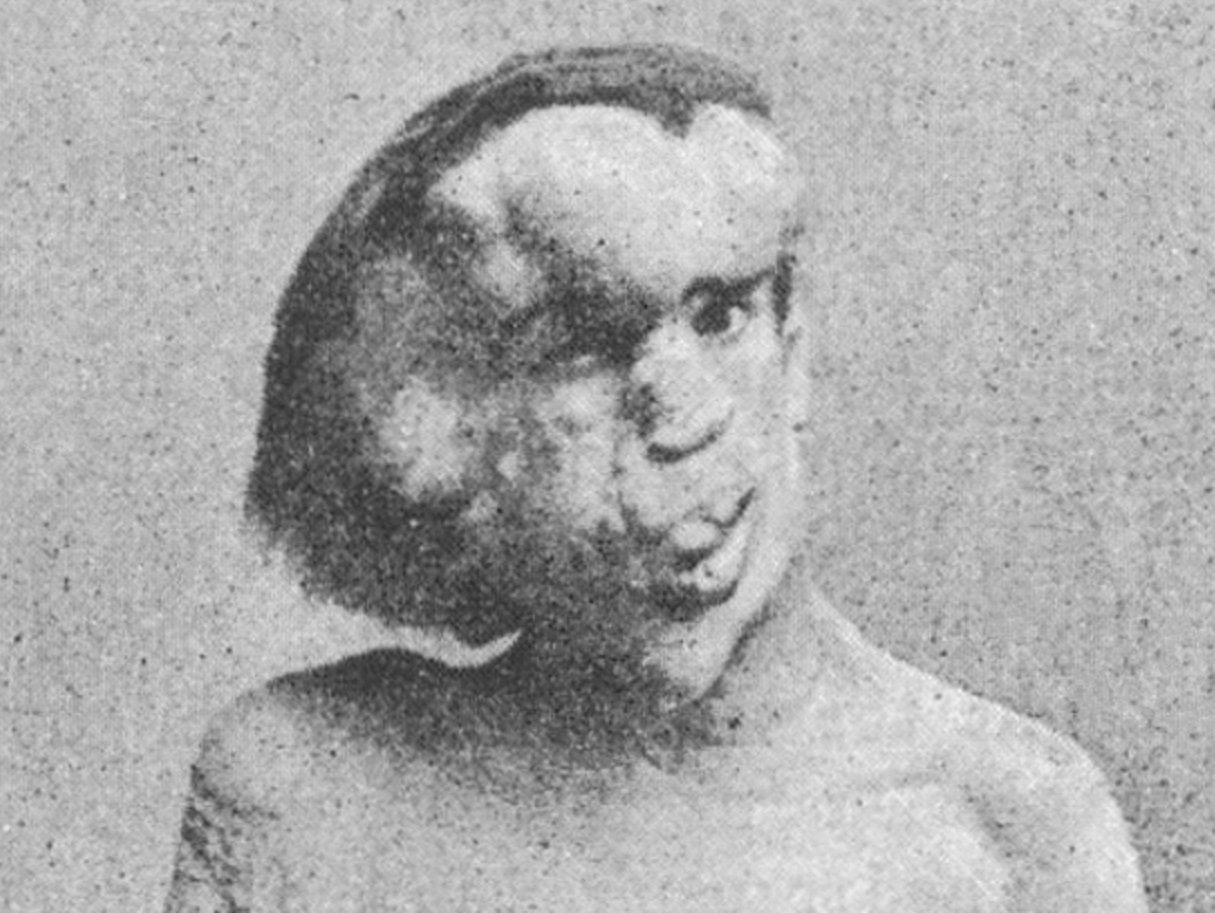 A photograph of Joseph Merrick, sometimes called the 