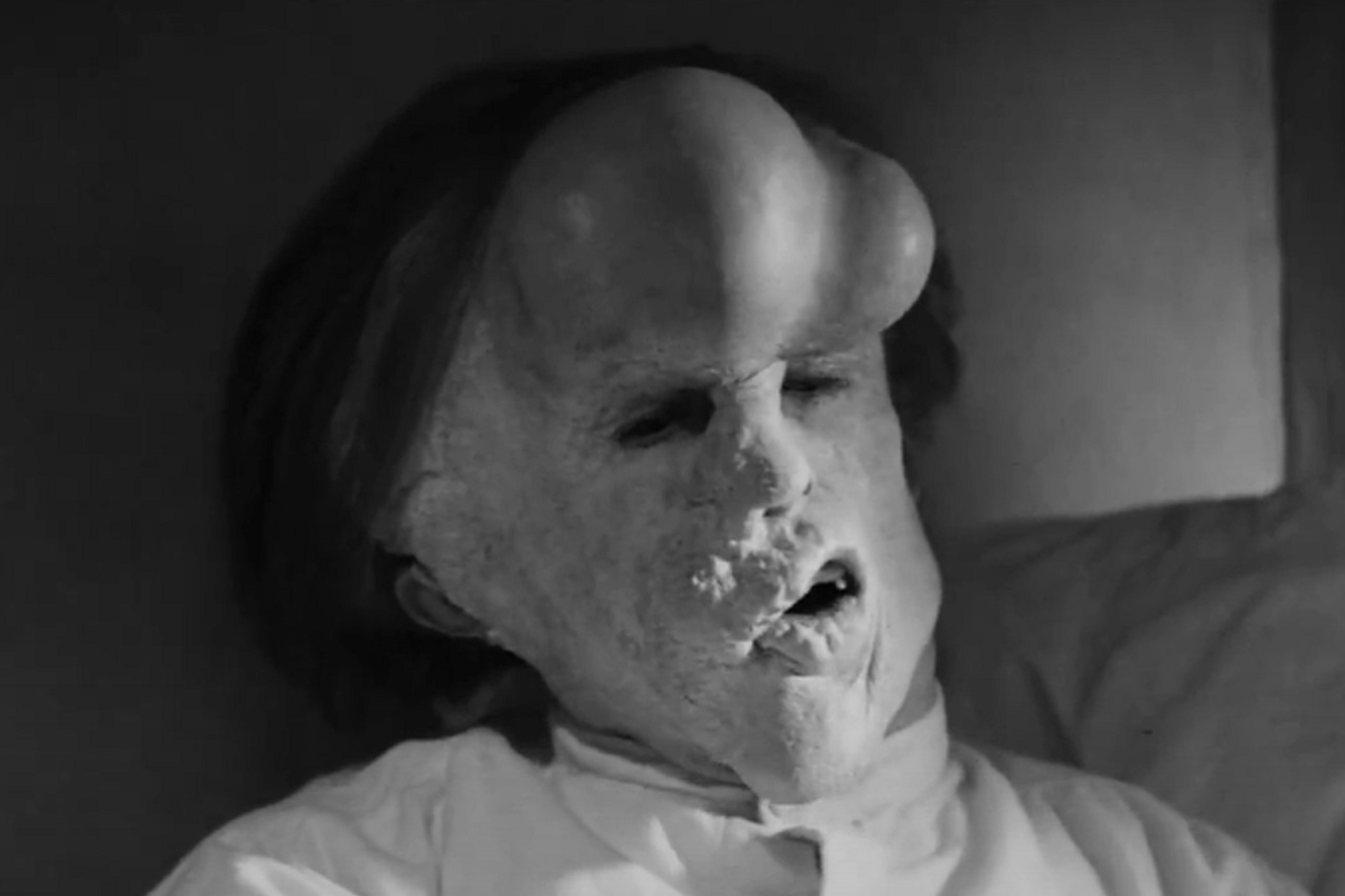 B&W Screenshot of Joseph Merrick (John Hurt) laying in bed in white shirt - from Elephant Man (1980)