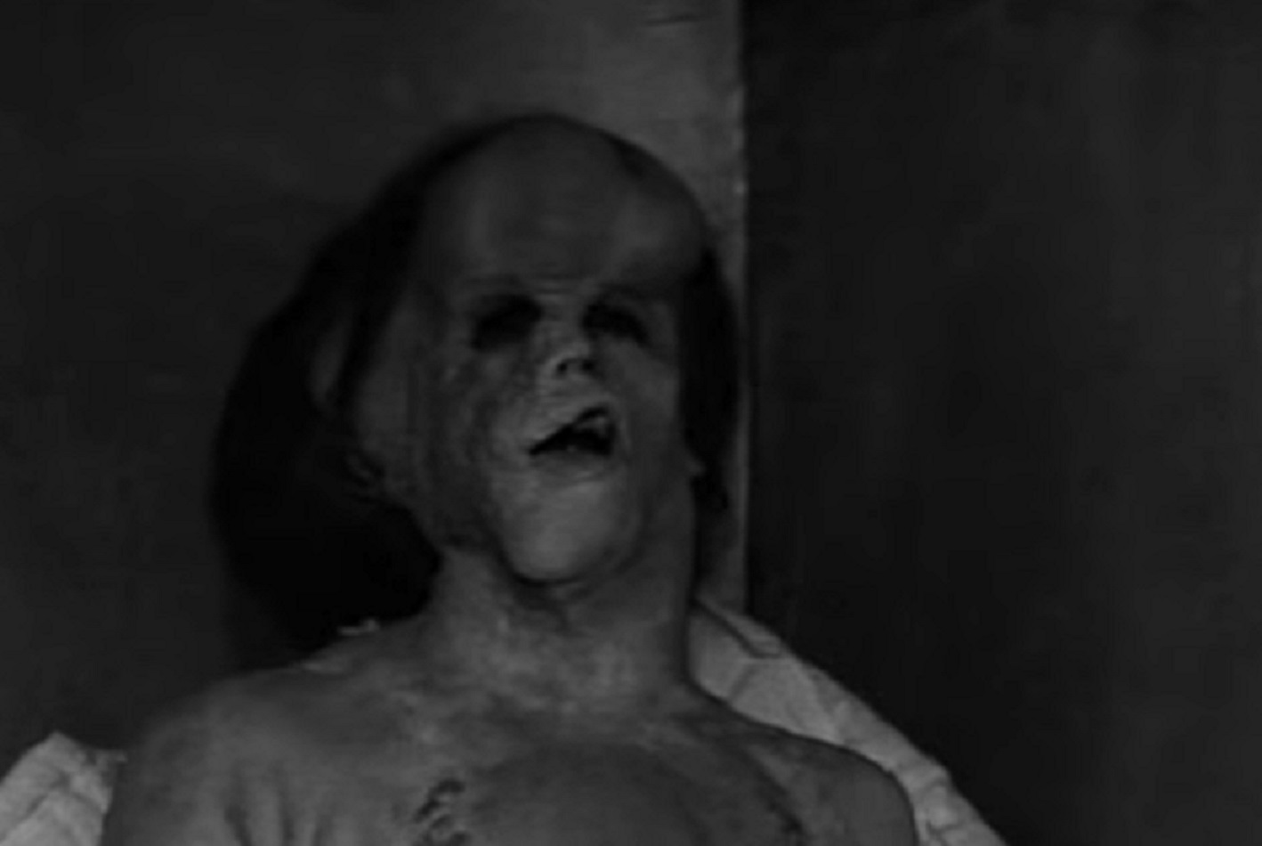 B&W Screenshot of Joseph Merrick (John Hurt) laying on bed with sad face - from Elephant Man (1980)