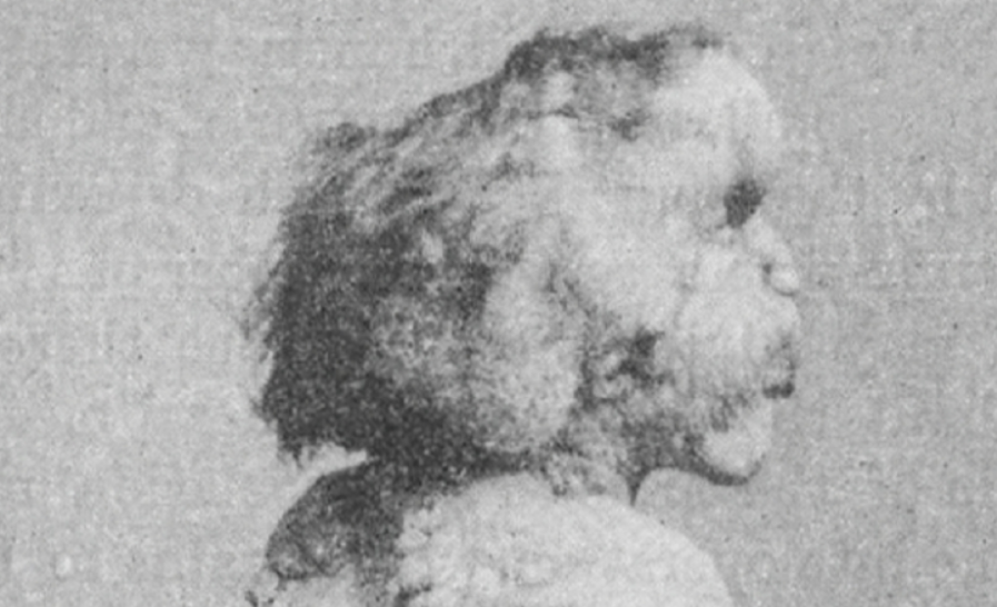 A photograph of Joseph Merrick, sometimes called the Elephant Man - 1889