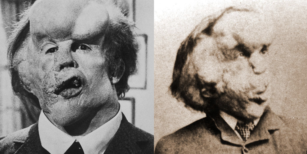 joseph merrick, elephant man