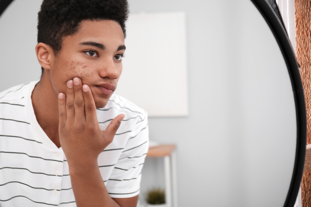 African-American teenage boy with acne problem at home looking reflection on mirror