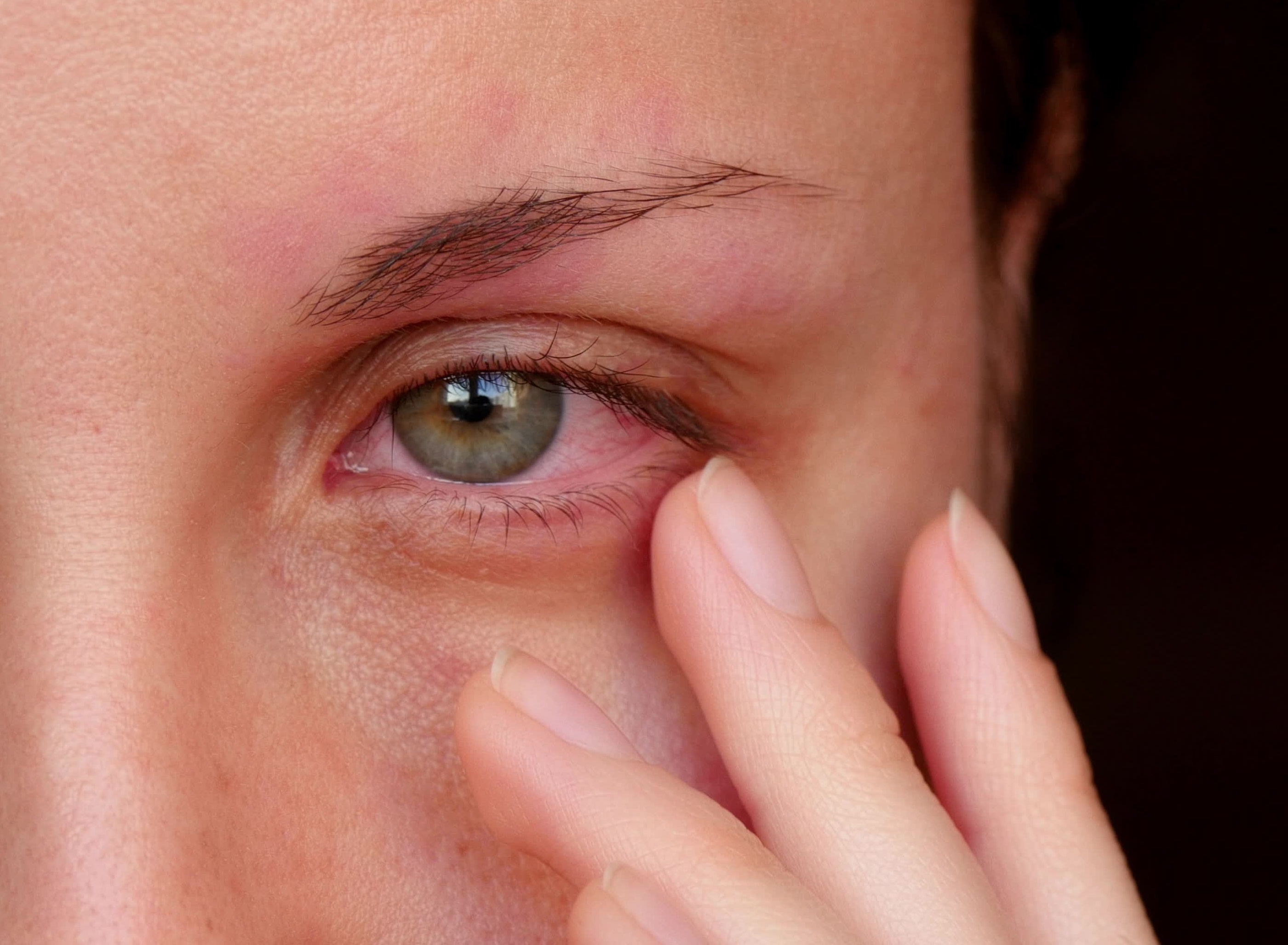 Close up photo of woman with red eye.