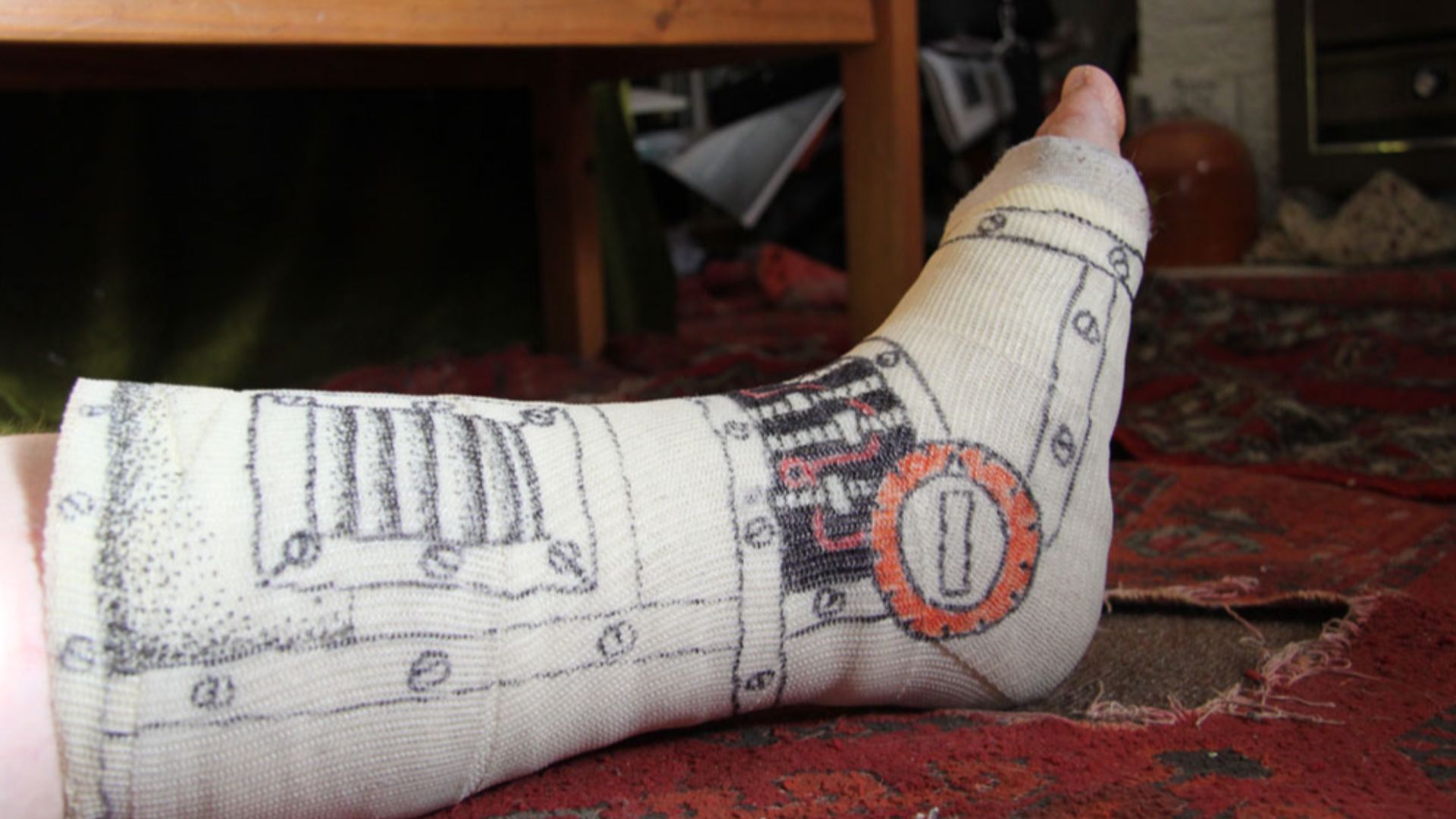 File:Broken ankle- Cast detail.jpg