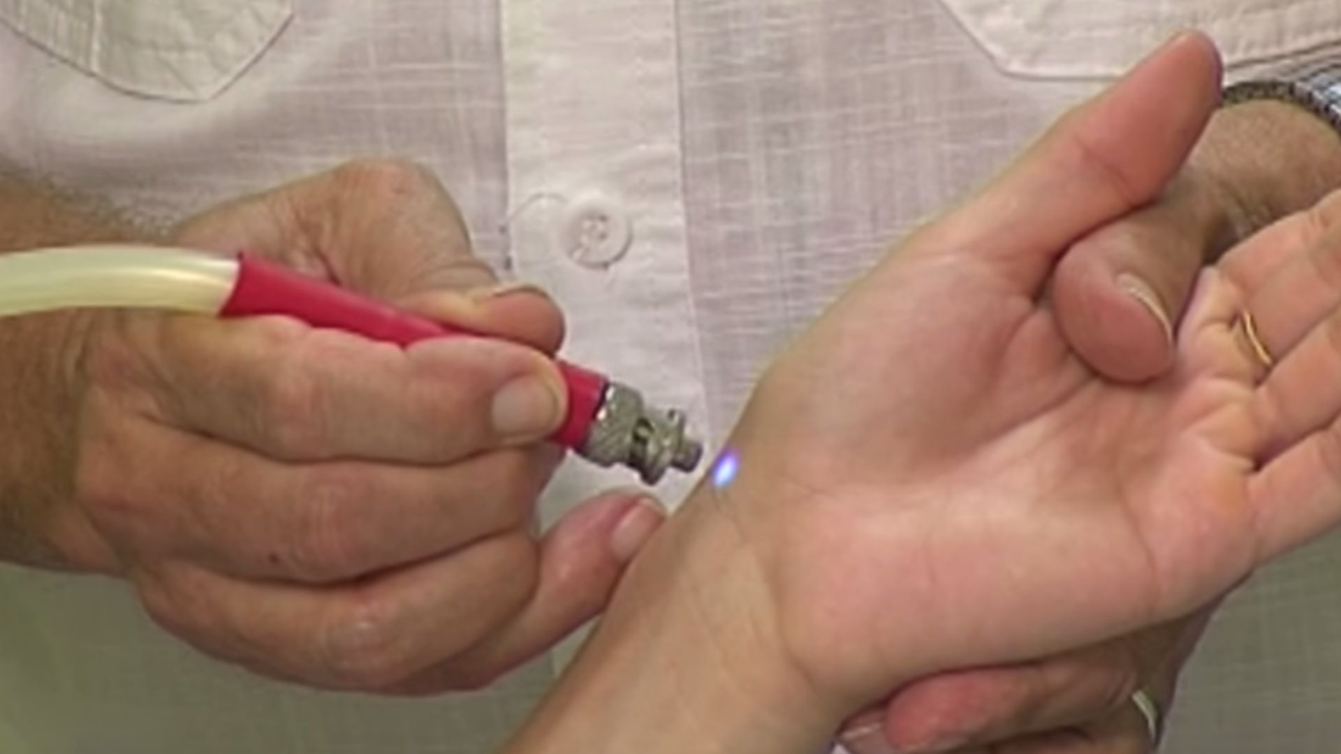 File:Cromountura - aplicación de luz azul en el punto 60 del canal del pulmón durante una sesión de cromopuntura.png