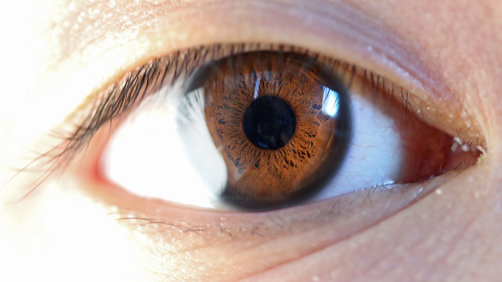 File:Human eye with limbal ring, anterior view.jpg