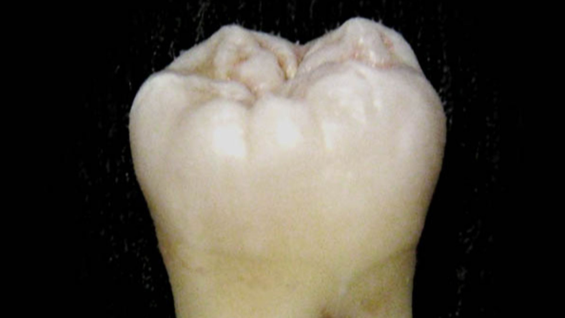 File:Lower wisdom tooth.jpg
