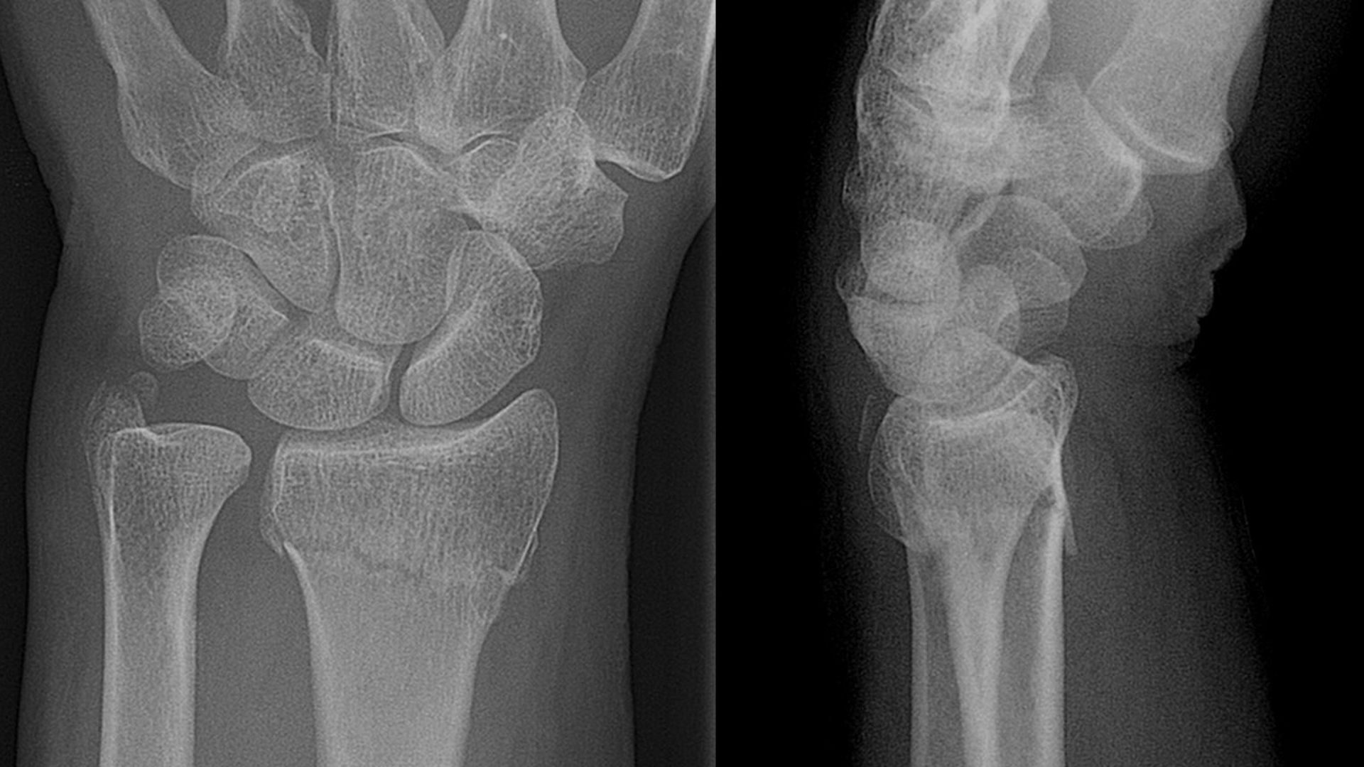 File:Colles' Fracture of Radius.jpg