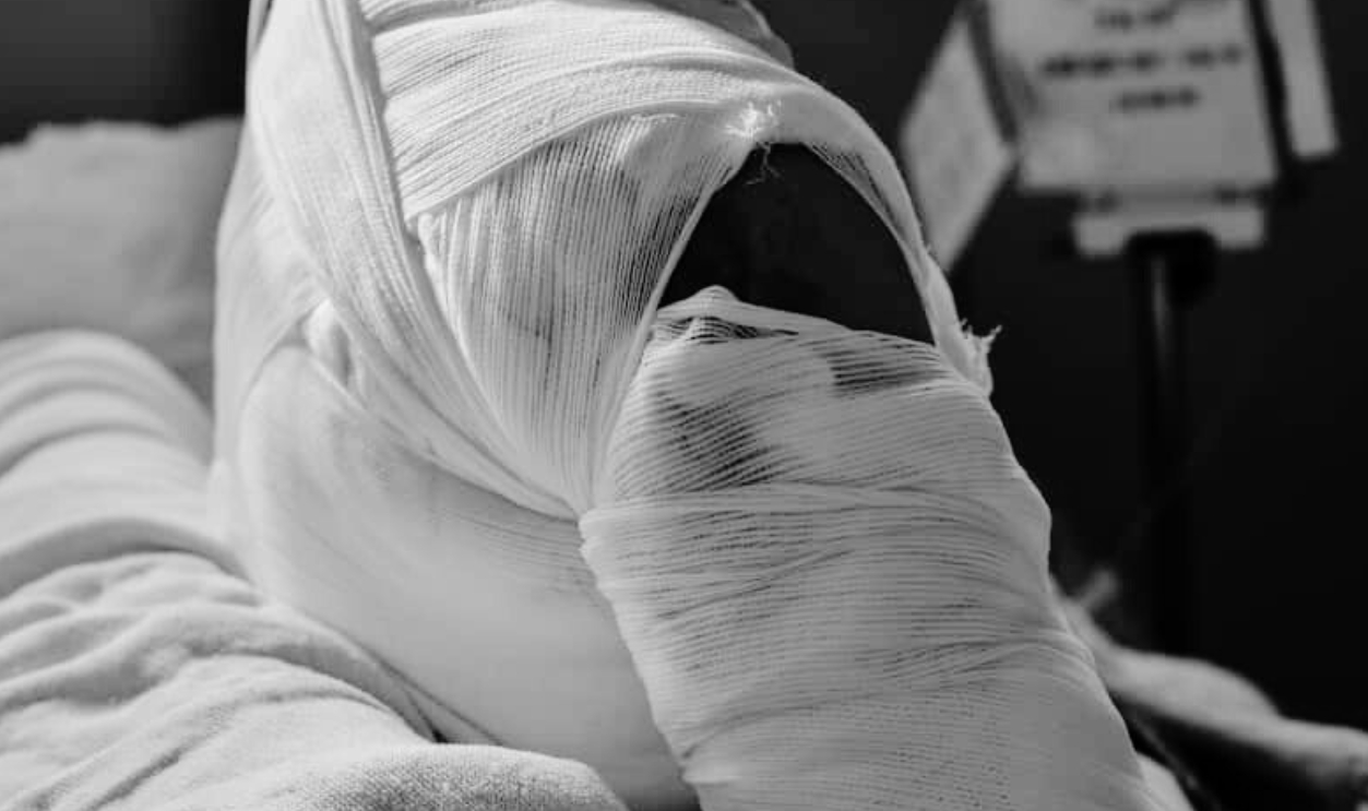 Patient With Burns Wound, Shutterstock, 1096223063