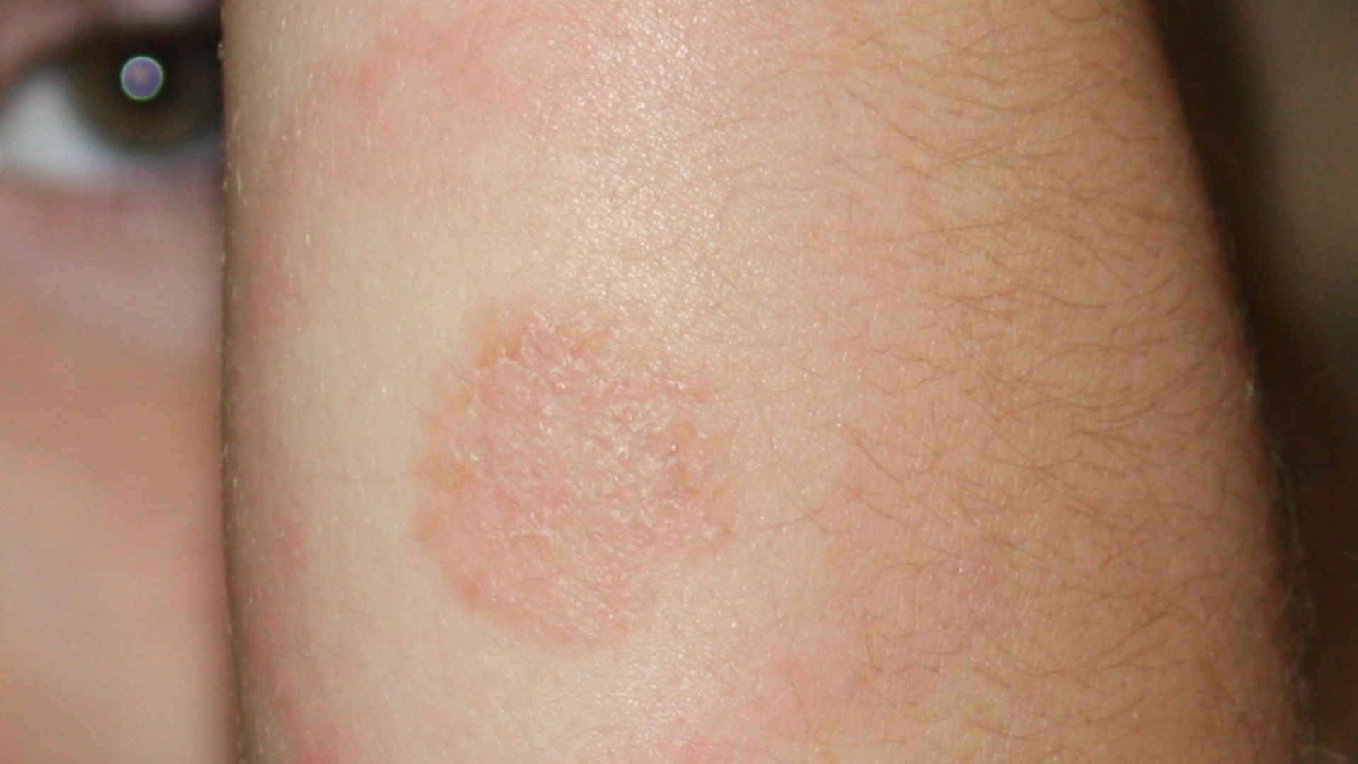 File:Lyme Disease Rash on 5 year old.jpg