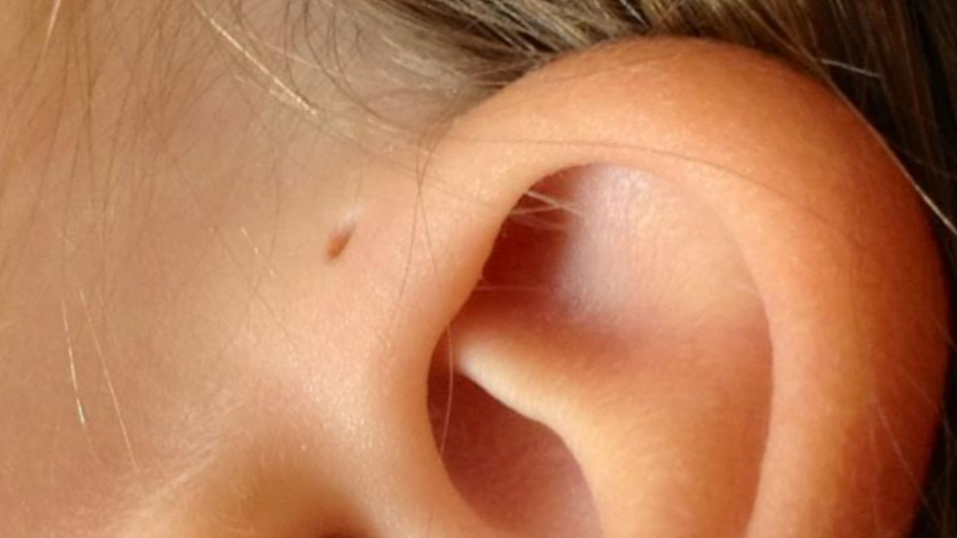 File:Preauricular sinus and cyst.jpg