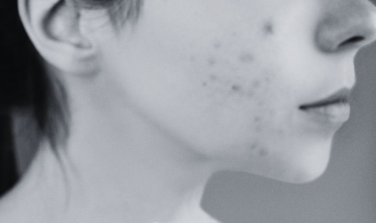 Close-up of a woman using a facial brush to care for acne-prone skin