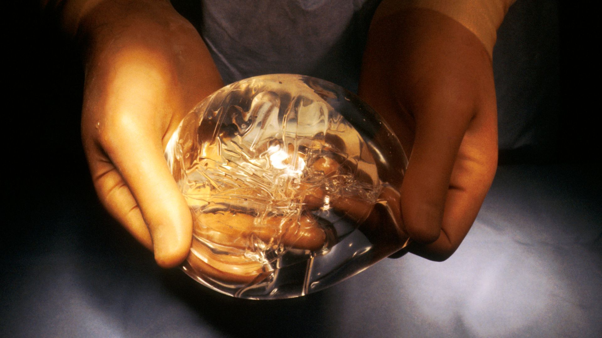 Title Breast Surgery Reconstruction
Description Hand holding a breast implant which is a flexible sac filled with silicone gel. A surgeon inserts the sac into the chest just under the skin. This implant can be inflated with air or injected with a saline s