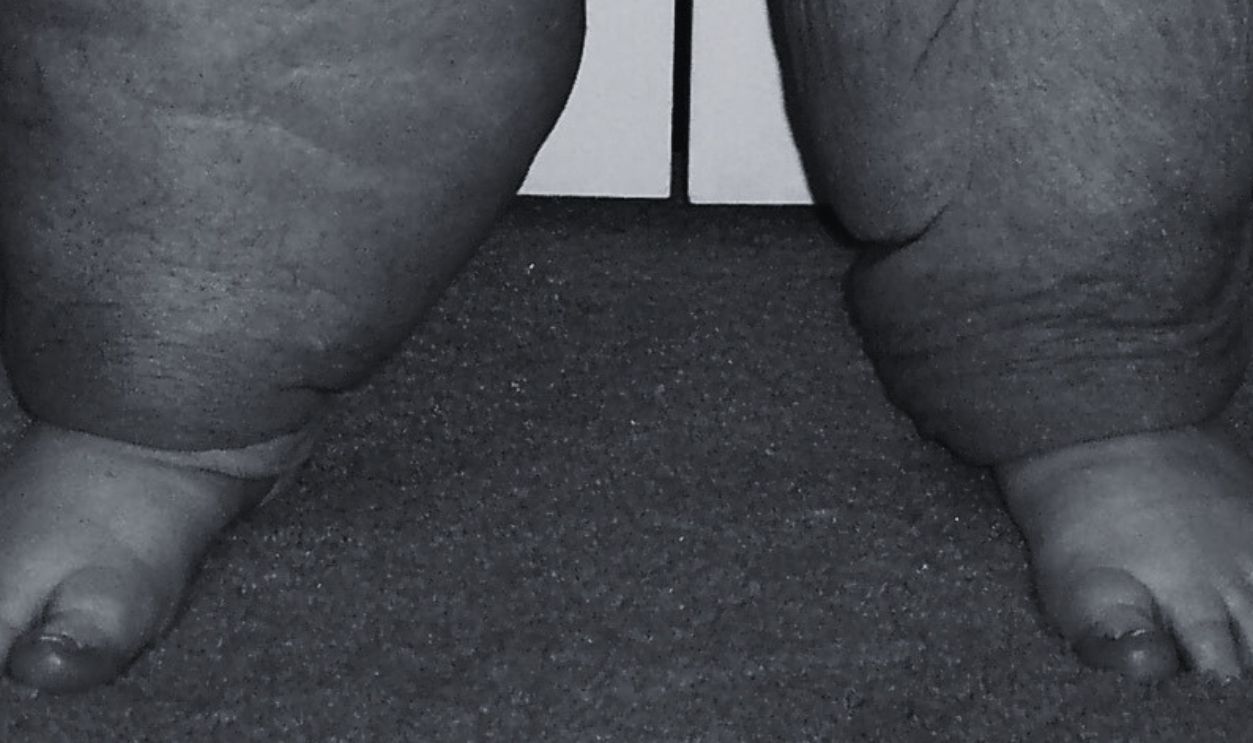 lymphedema  