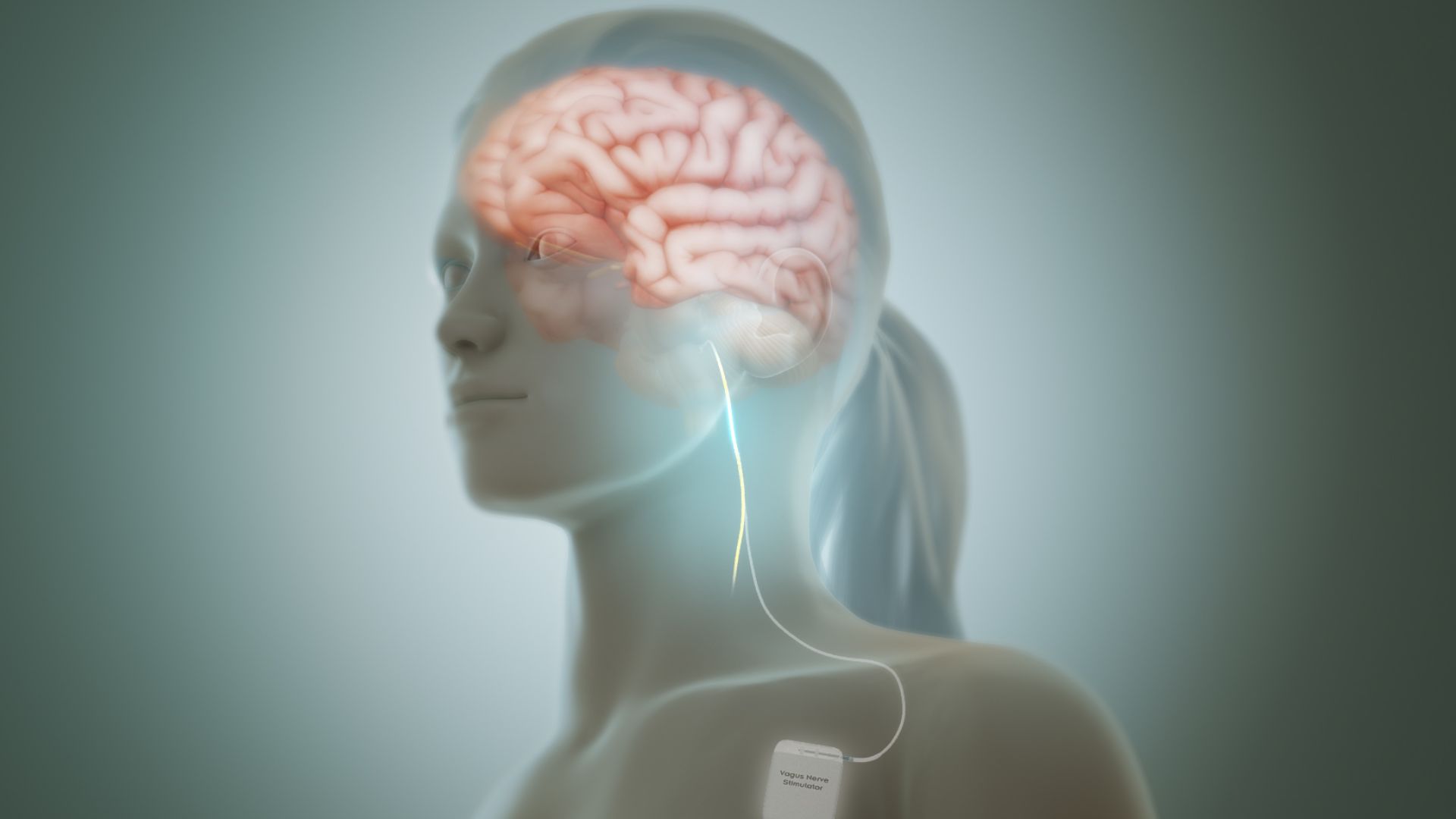 File:Vagus nerve stimulation.jpg
