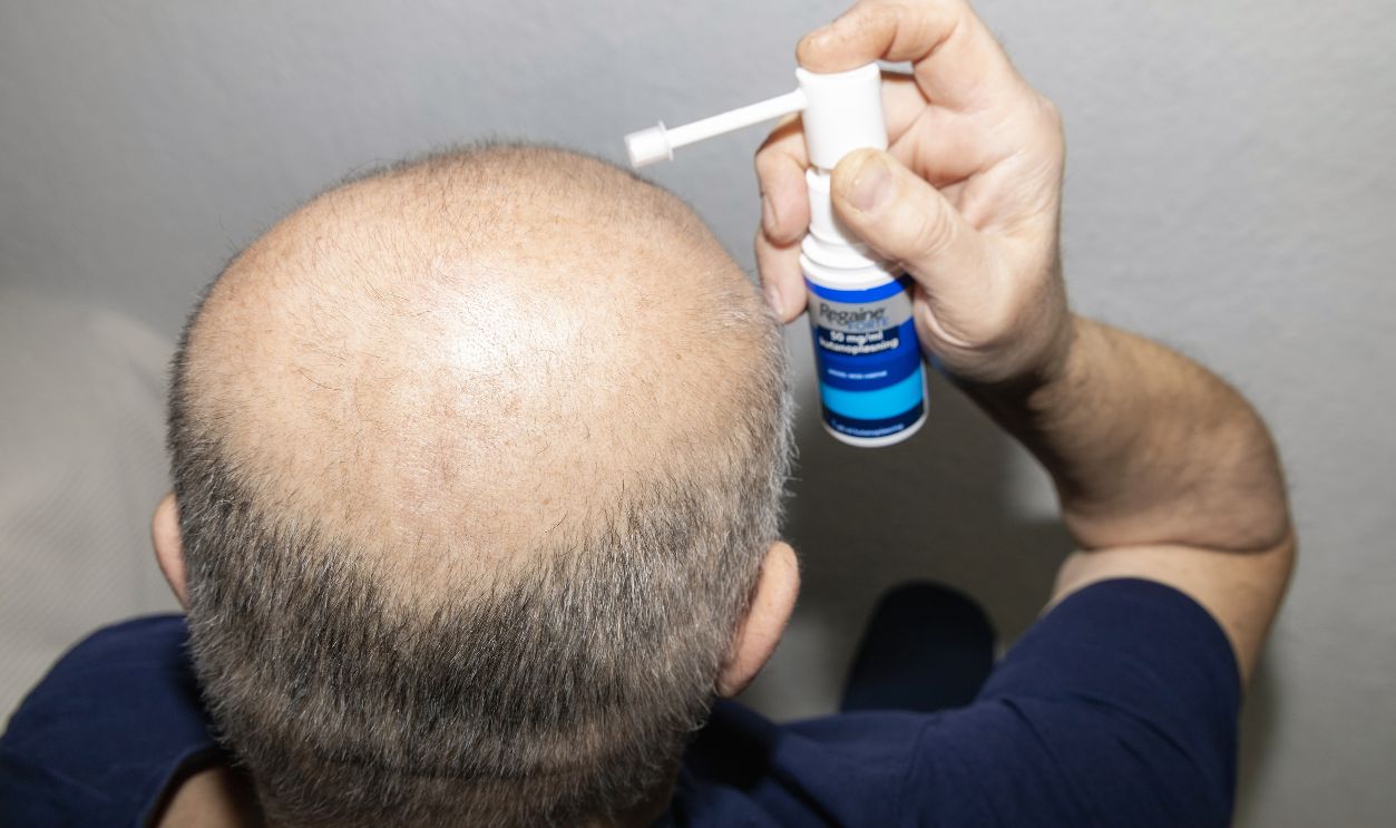 Man applying Regaine Forte topical hair loss treatment. Copenhagen, Denmark