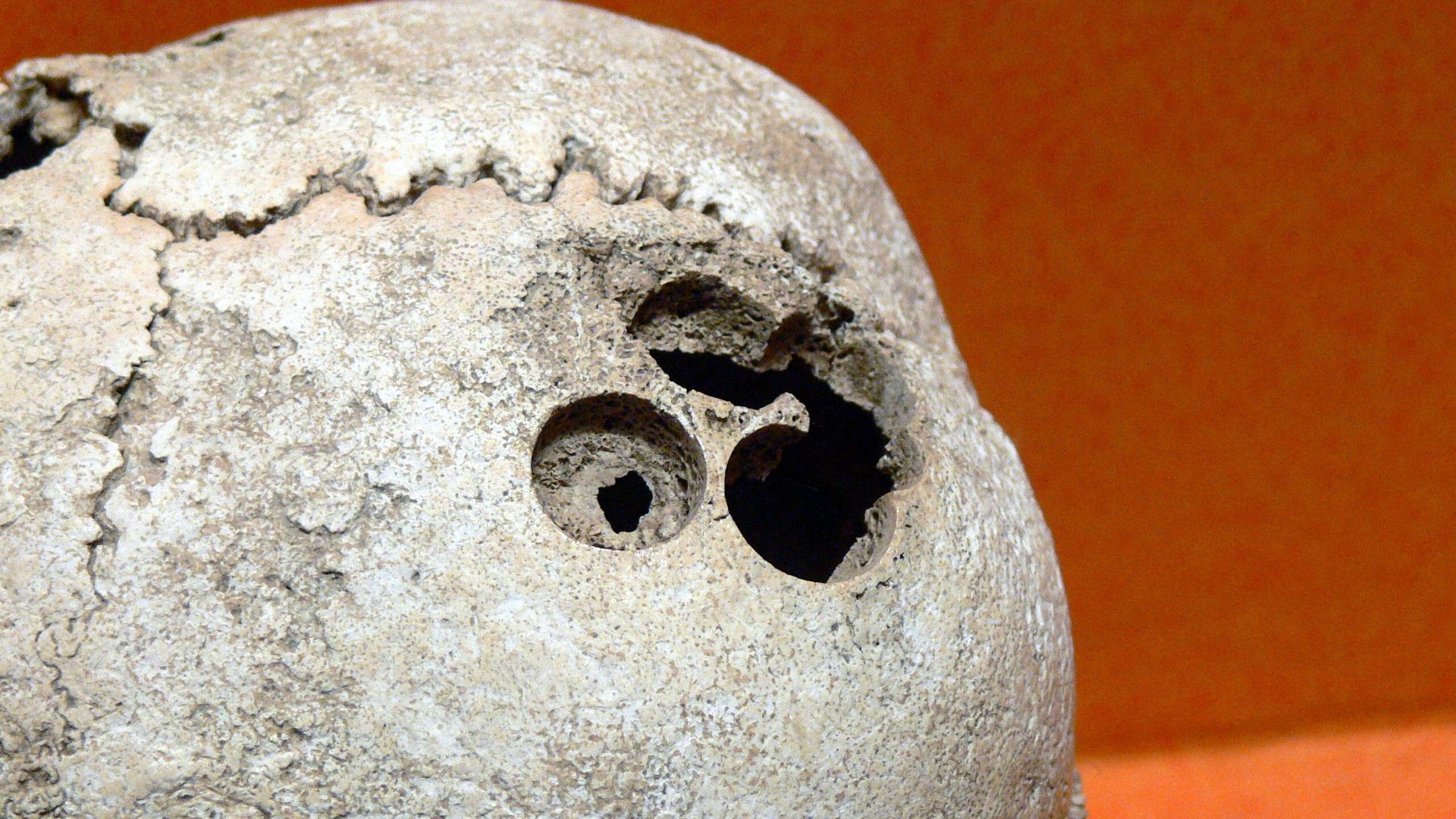 Monte Albán - Museo del Sitio. Trepanation holes in a human skull