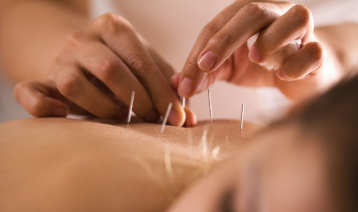 The doctor sticks needles into the girl's body on the acupuncture