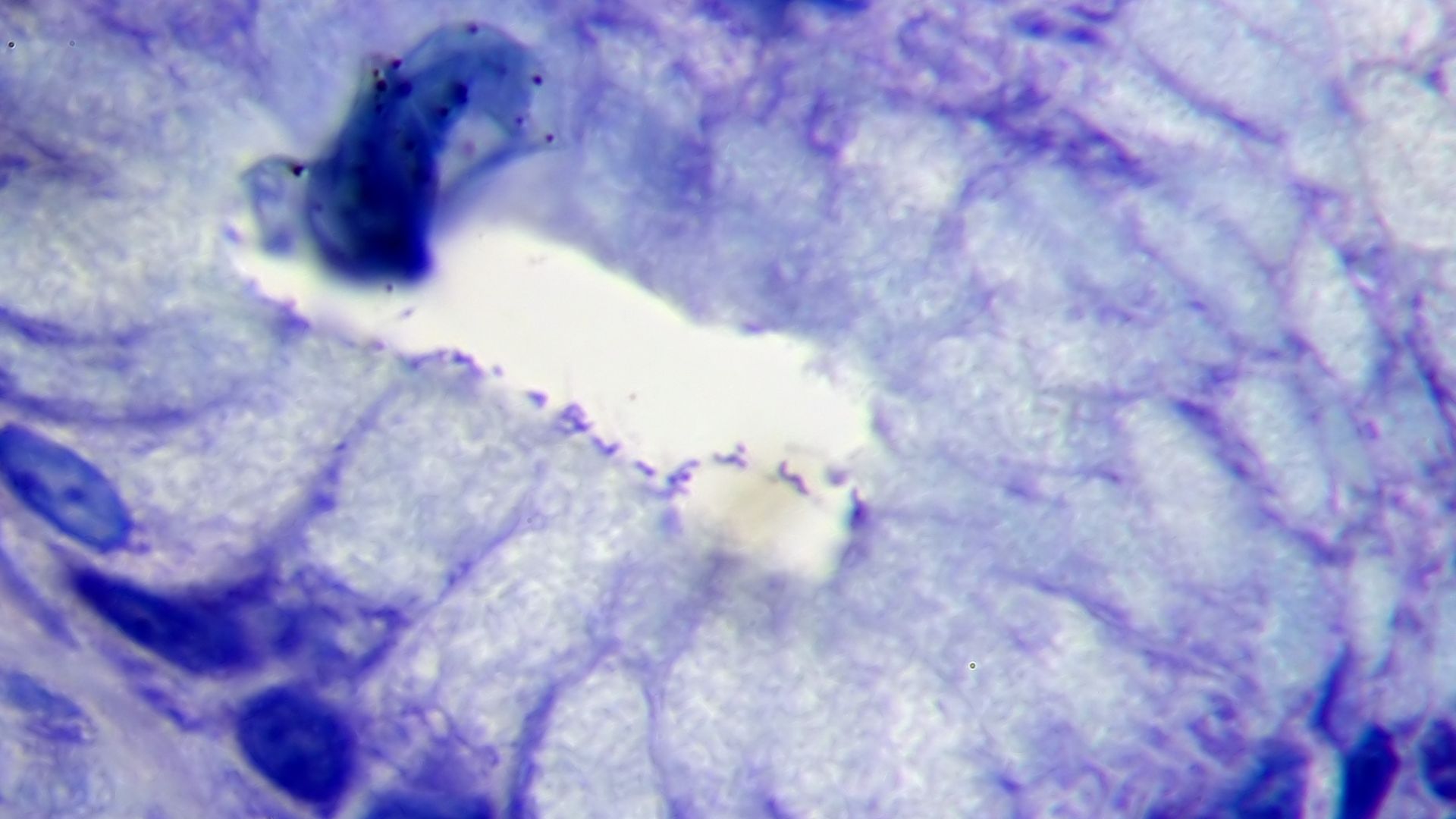 gastritis due to Helicobacter pylori.