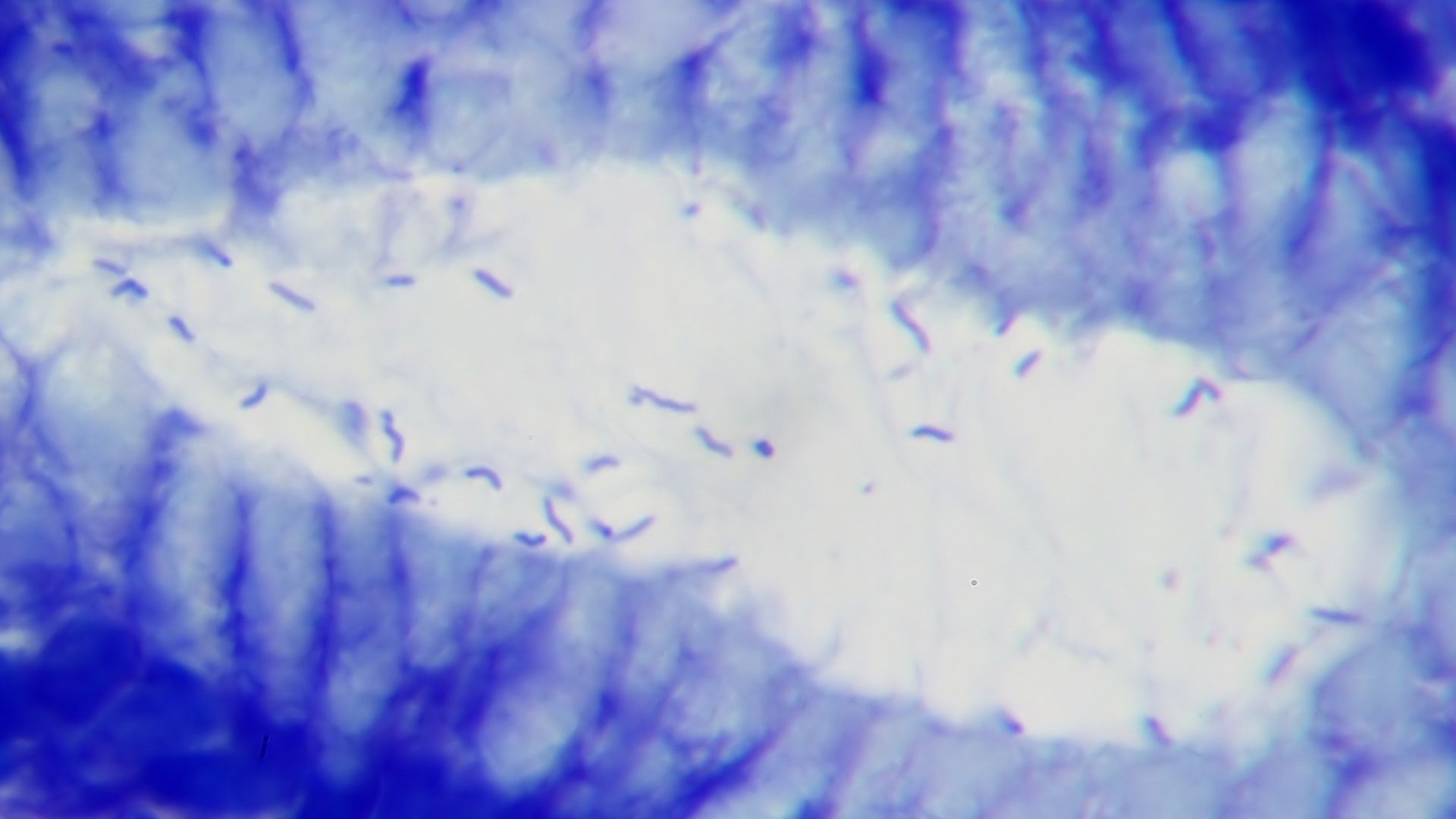 Helicobacter pylori in a case of gastritis.