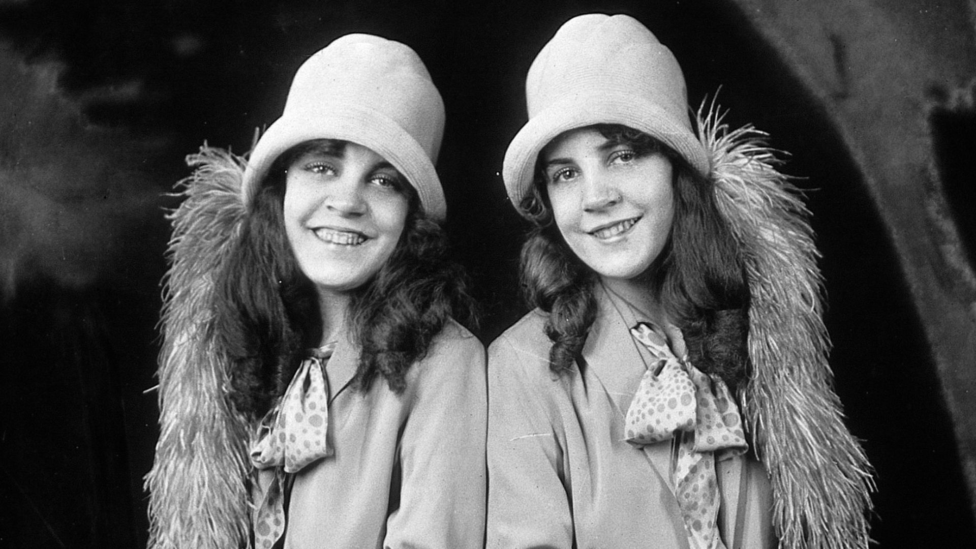 Daisy and Violet Hilton, conjoined twins