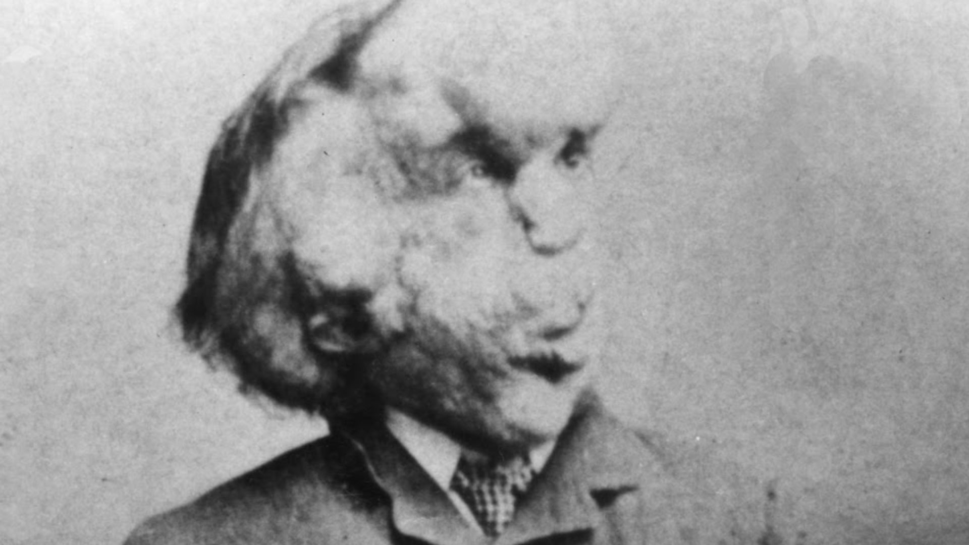 Joseph Merrick (1862-1890). The photograph was circulated to members of the public c. 1889 as a Carte de visite. This photograph was first published in The Elephant Man: A Study in Human Dignity by Ashley Montagu (first published in London and the United 