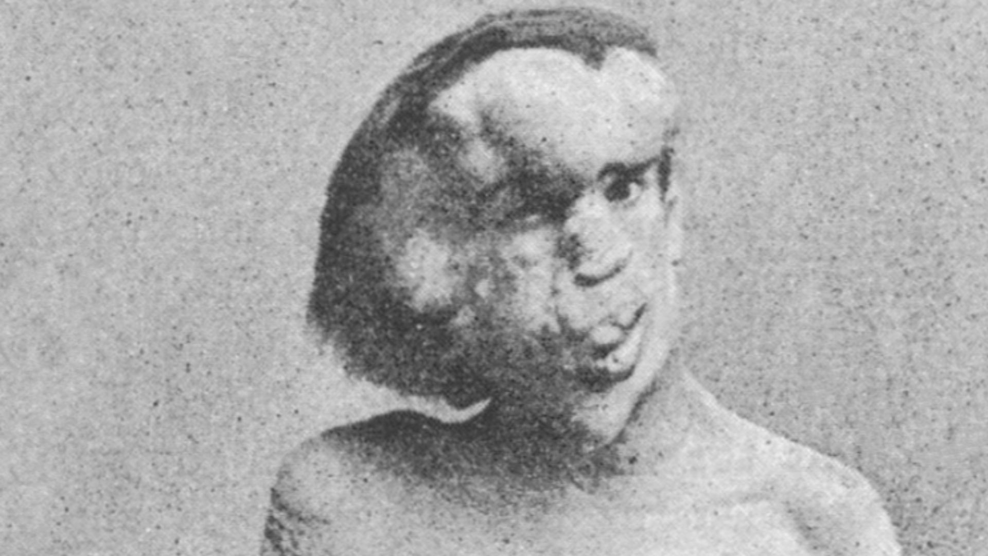 A photograph of Joseph Merrick (1862–1890), sometimes called the