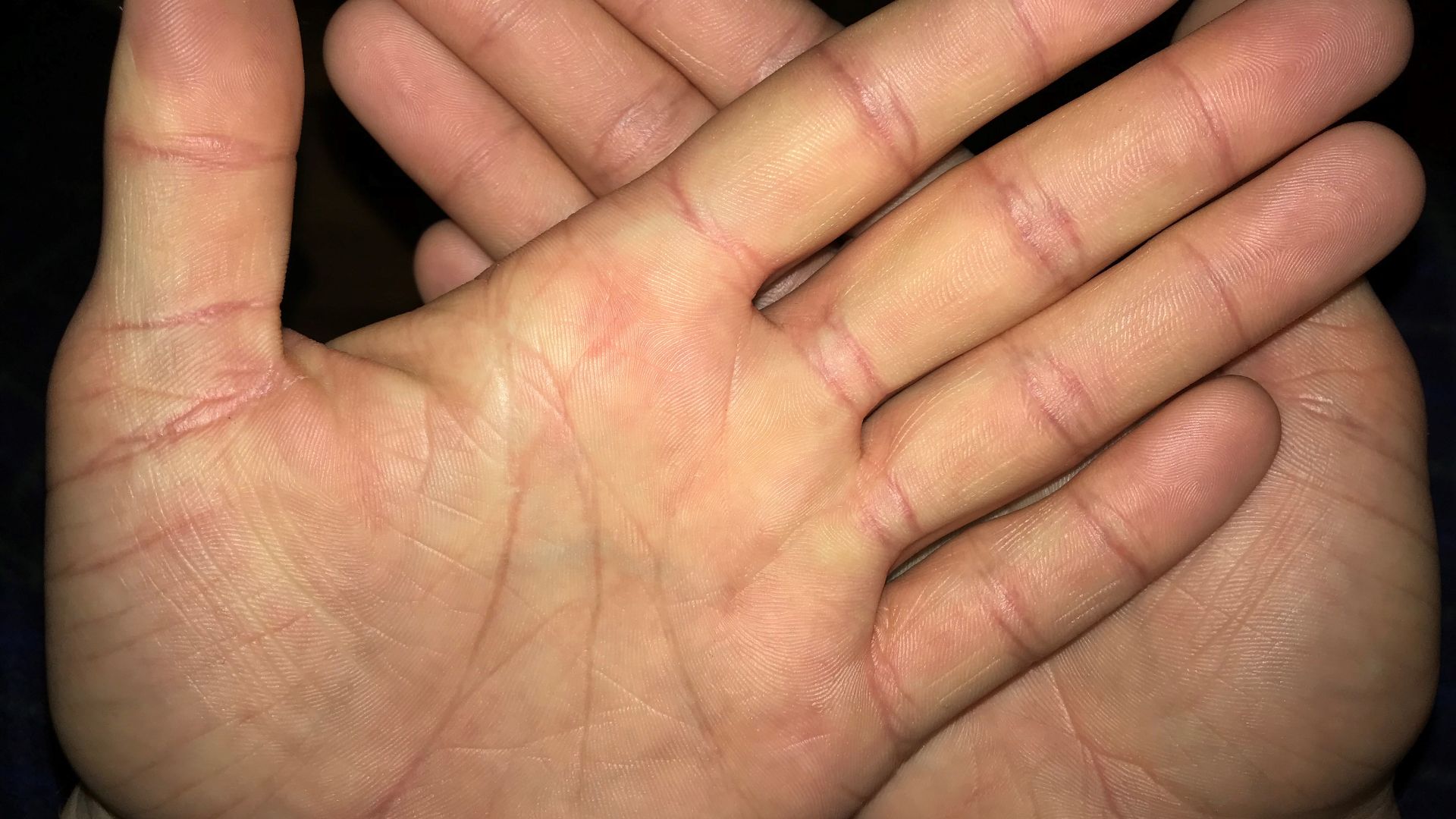 Both palms open with focus on the left, showcasing unique features and texture of the hand including palm lines and fingerprints