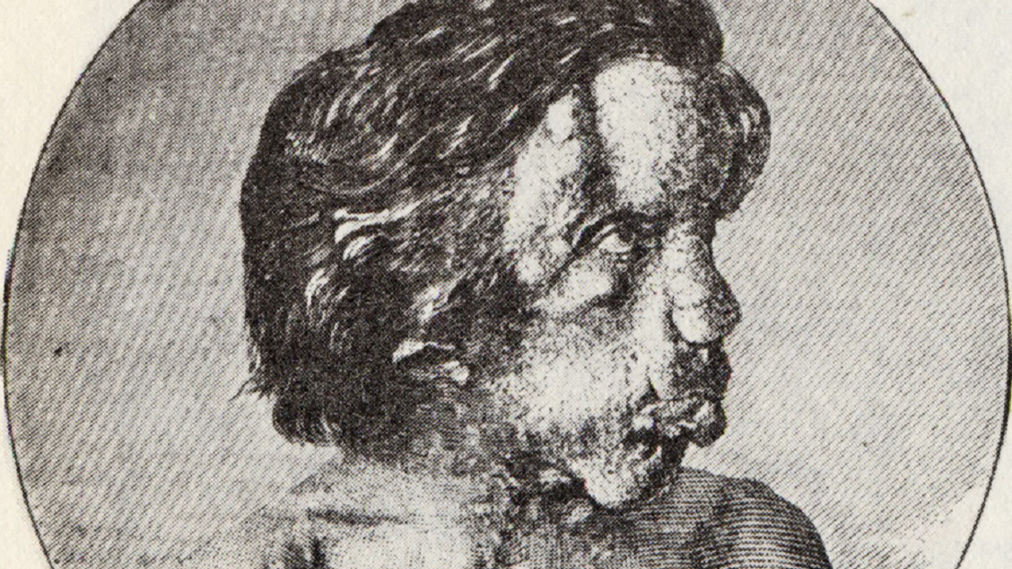 B&W image of Joseph Merrick looking at side - 1886.
