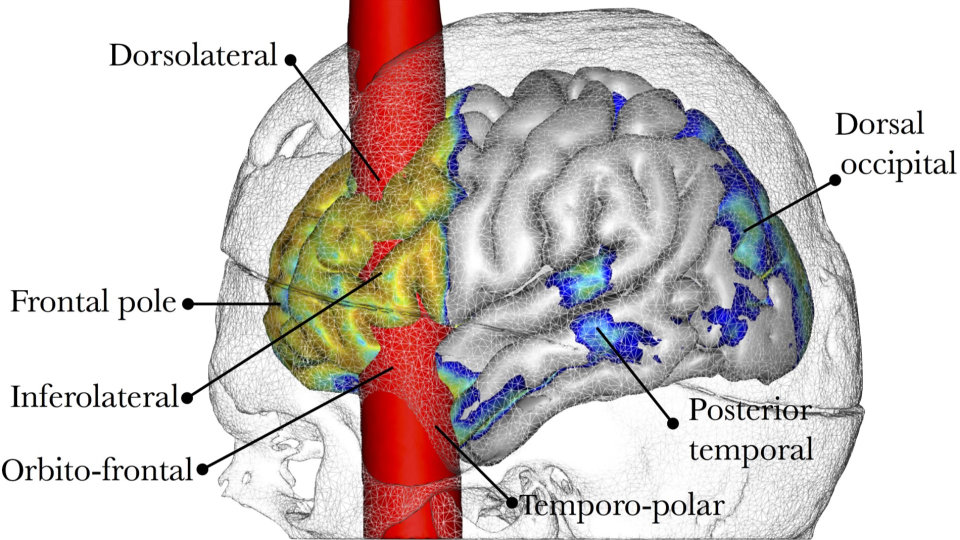 3D reconstruction of Gage's skull co-registered. The trajectory of the bar through the brain is in red and shows damage to cortical areas and subcortical white matter.