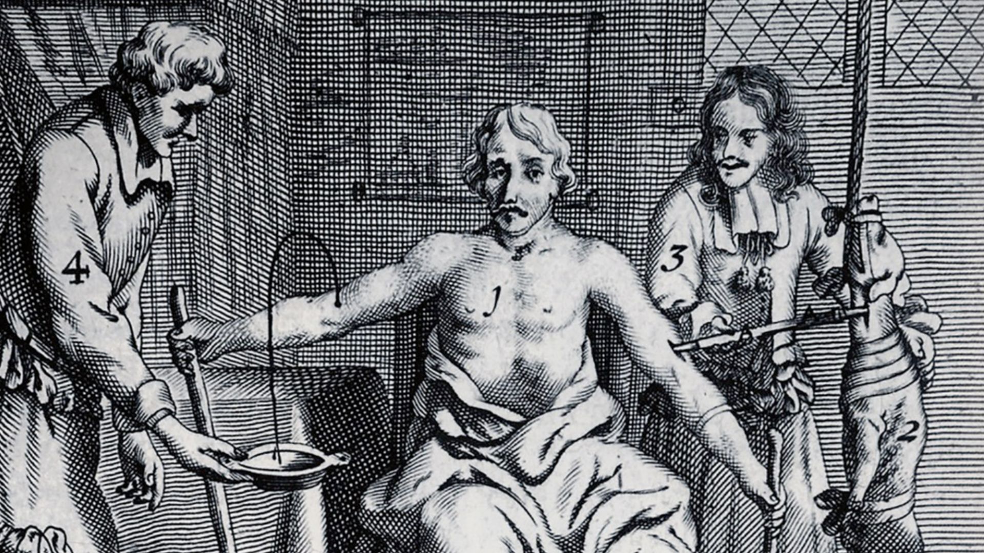 Patient is bled and receives a dog's blood transfusion. Johannes Scultetus, Armamentarium Chirurgicum, 1693 edition.