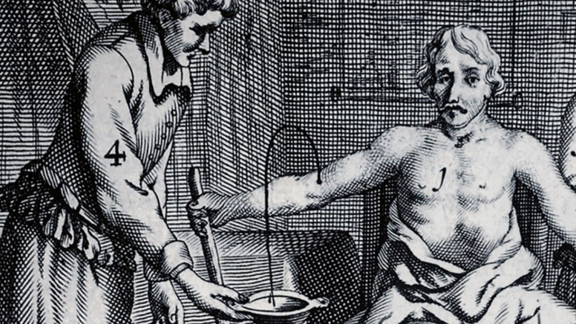 Patient is bled and receives a dog's blood transfusion. Johannes Scultetus, Armamentarium Chirurgicum, 1693 edition.