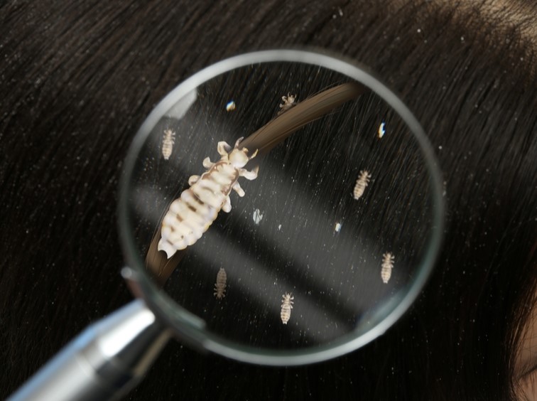 Woman with lice and nits