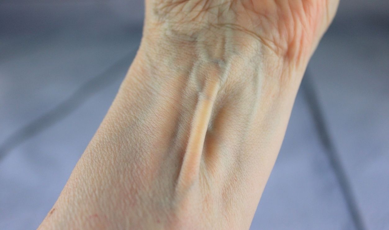 Palmaris longus muscle, visible tendon located between the flexor carpi radialis and the flexor carpi ulnaris, although it is not always present as its a Vestigial of evolution