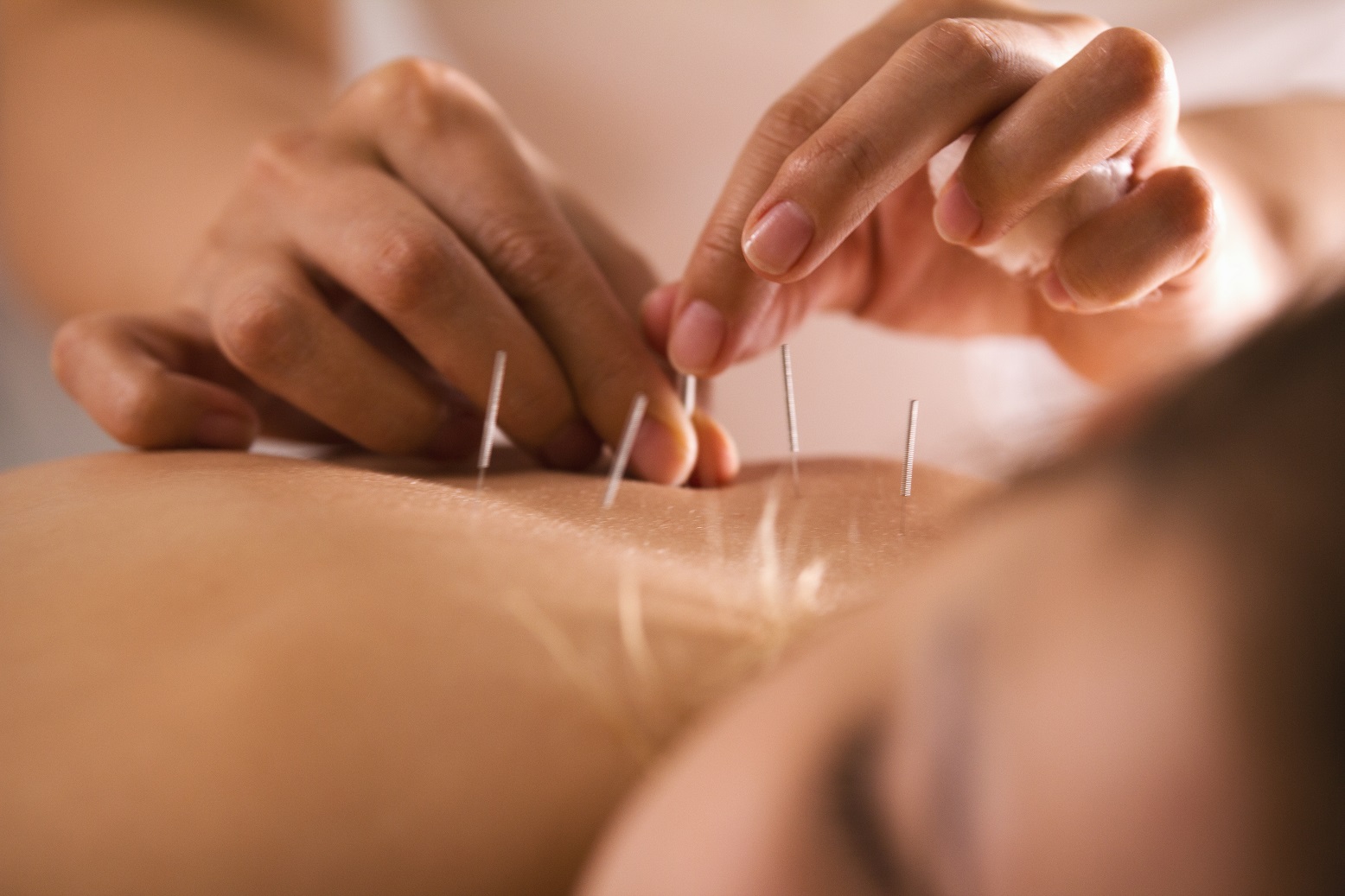 The doctor sticks needles into the girl's body on the acupuncture.