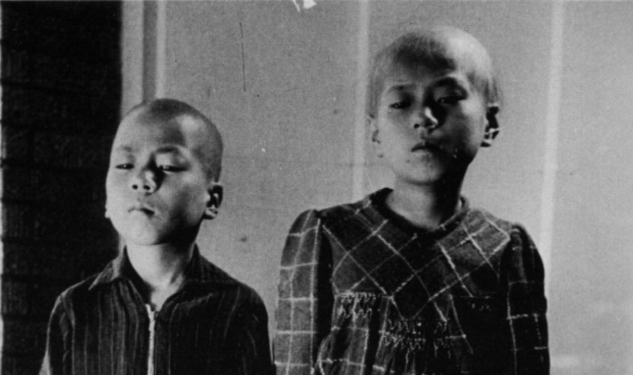 Elder sister and younger brother who lost their hair by aftereffects of atomic bomb